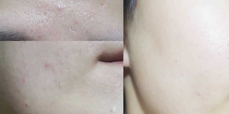 여드름 일주일 만에 정복하기!