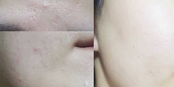 여드름 일주일 만에 정복하기!