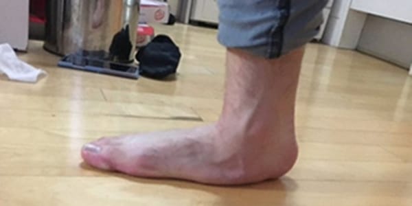 저는 평발로 군대를 면제 받았습니다